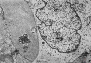 M,11y. | fibrillary astrocytoma